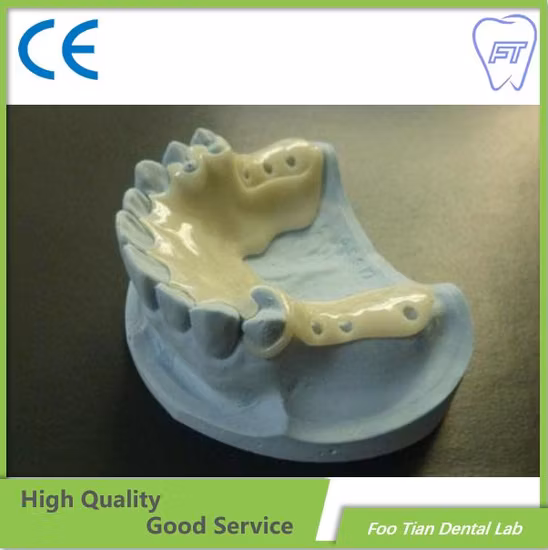 Cast Partial Framework Removable Denture Dental