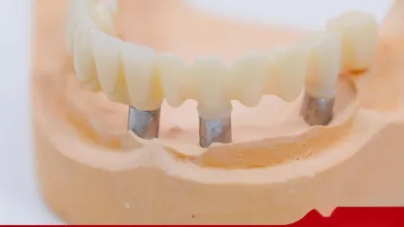 임플란트 크라운을 위한 치과용 3D 프린팅